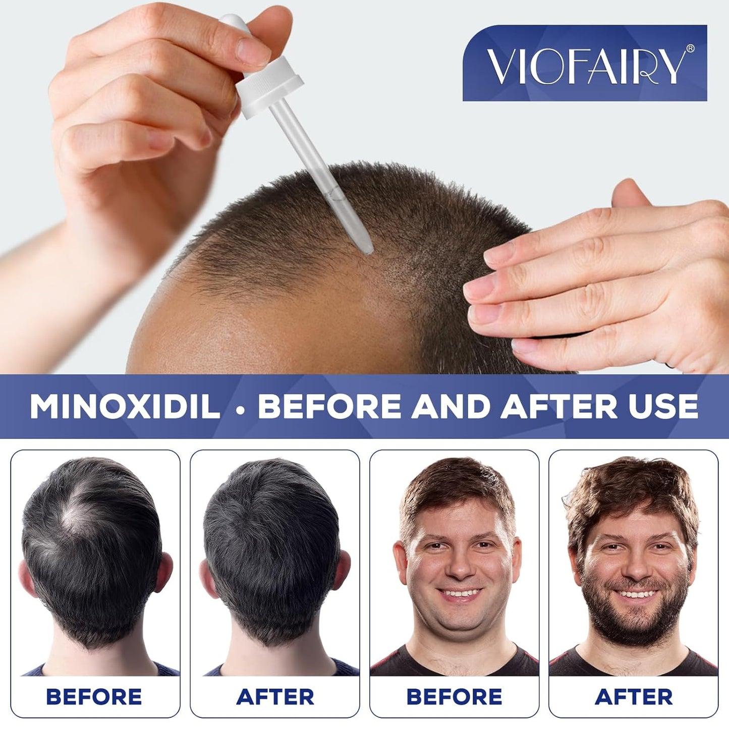 5% Minoxidil for Men and Women, Hair Regrowth Treatment for Thinning Hair and Hair Loss, Topical Solution - 3 Months Supply - Dermatologist recommended (Pack of 3)