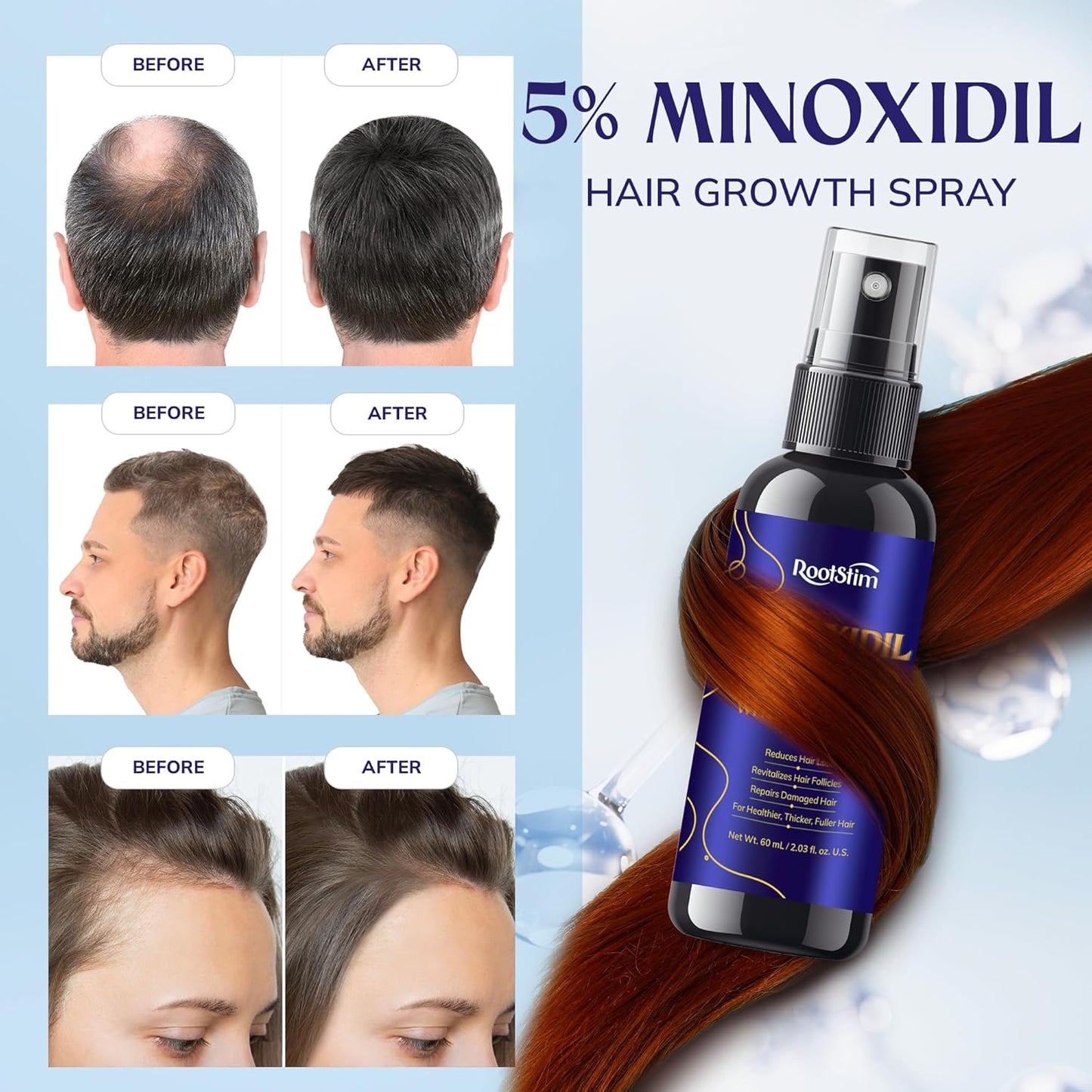 5% Minoxidil Hair Growth for Men and Women: 3-Pack RootStim Extra Strength Minoxidil with Rosemary for Thinning Hair Regrowth and Fuller Hair 180 ML